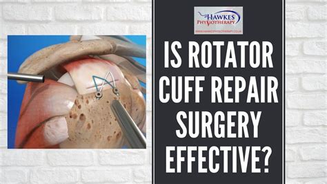 Is Rotator Cuff Repair Surgery Effective Hawkes
