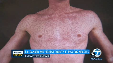 Measles Outbreak La County Is 2nd Most Vulnerable Place In Country
