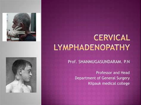 Ppt Cervical Lymphadenopathy Powerpoint Presentation Free Download