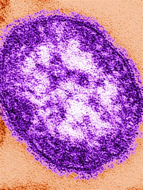 Measles Kills First Patient In 12 Years