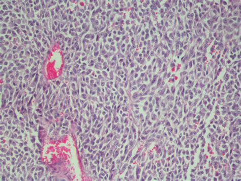 Pathology Outlines Melanocytic Tumors Melanoma