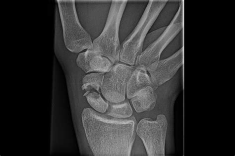 Ortho Dx Chronic Right Wrist Pain Clinical Advisor