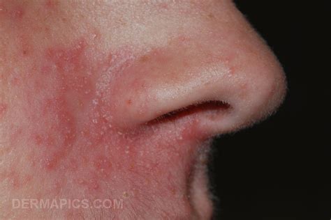 Perioral Dermatitis Pictures And Clinical Information From The