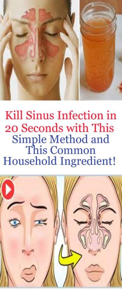 A Sinus Infection Is A Very Common Condition About 37 Million
