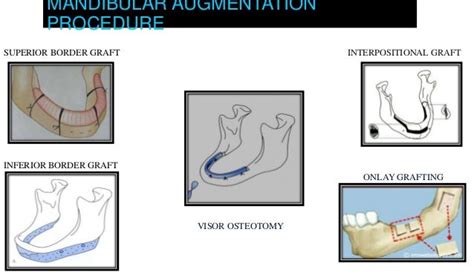 Methods To Improve Com Lete Denture Foundation 2