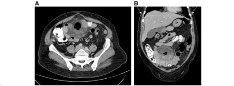 Ct Of The Abdomen With Oral And Iv Contrast A Axial Image Of The