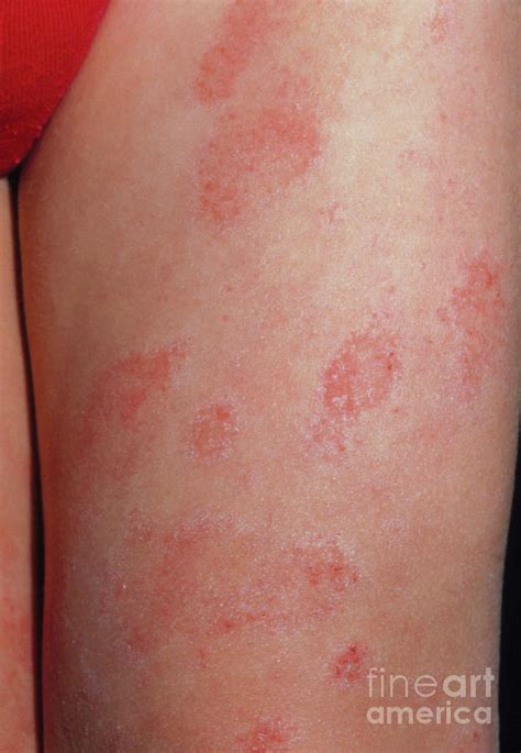 Eczema On The Leg Of A Child Photograph By Dr Hcrobinsonscience