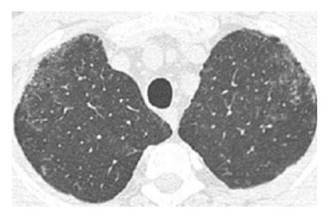 Respiratory Bronchiolitis Associated Interstitial Lung Disease