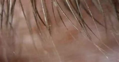 Womans Gruesome Mite Infestation On Eyelashes Shows How Important It