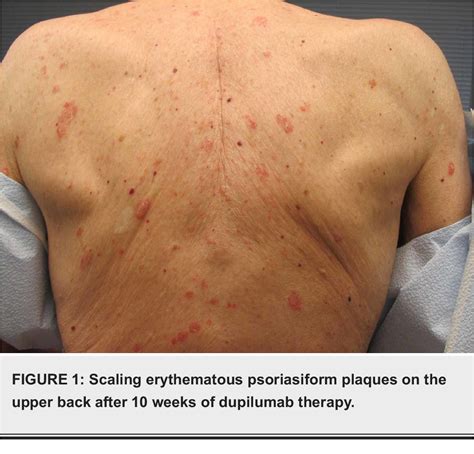 Figure 1 From Clinical Psoriasiform Dermatitis Following Dupilumab Use