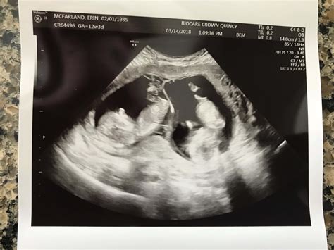 12 weeks pregnant ultrasound girl