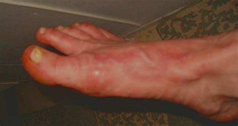 A Foot Rash On Curezone Image Gallery