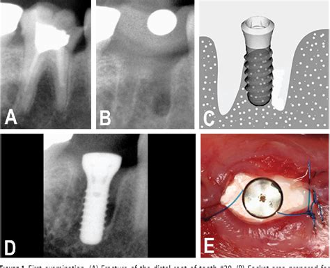 Figure 1 From Immediate Implant Placement In Fresh Mandibular Molar