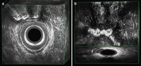 Three Dimensional Endoanal Ultrasonography Of The Anorectal Region Radiology Key