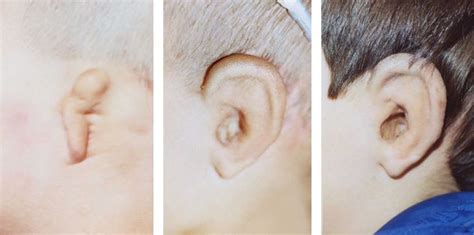 Atlanta Ear Reconstruction Microtia Before And After Photos