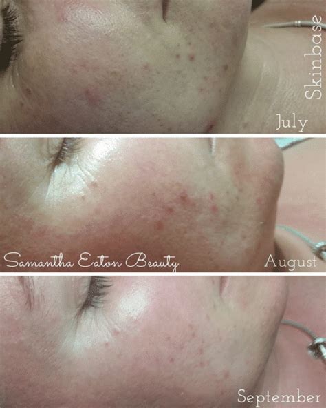 Skinbase Transformation Before And After Microdermabrasion