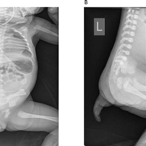 Ap And Lateral X Ray Views Of The Infant Chest And Abdomen A Ap X Ray