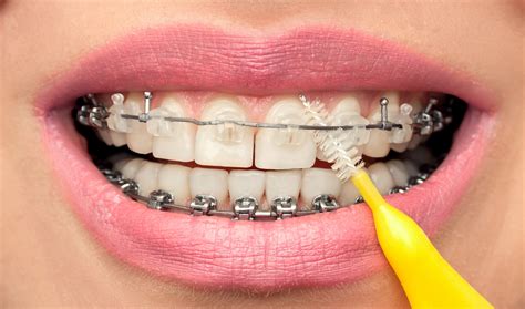 Dental Hygiene Of Teeth With Braces With Interdental Brush Odontológico Cervantes