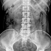 Lumbar radiology is usually two views; CSC » X-ray lumbar spine