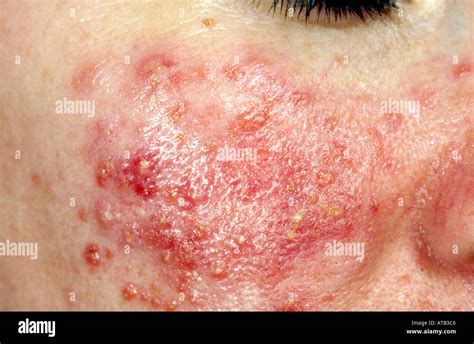 Papules Hi Res Stock Photography And Images Alamy