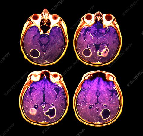 Brain Abscesses Mri Scan Stock Image M1080776 Science Photo Library