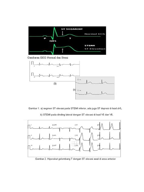 Gambaran Ekg Normal Dan Stemi Pdf