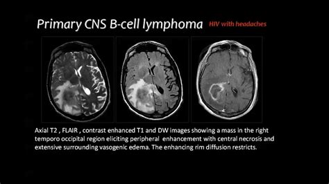 Radiology Imaging B Cell Occipital Ct Scan Lymphoma Cns Pathology