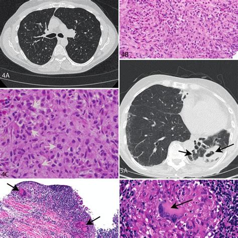 Transbronchial Lung Biopsies Menu Of Nonneoplastic Diagnoses With Key