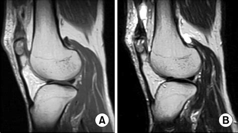 Sagittal Images Of The Knee Mri A Sagittal T1 Weighted Mri Of The