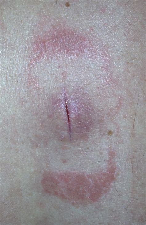 Abscess Incision And Drainage A Photographic Tutorial Jail Medicine