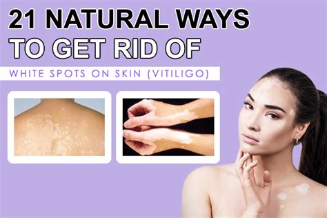 21 Natural Ways To Get Rid Of White Spots On Skin Vitiligo