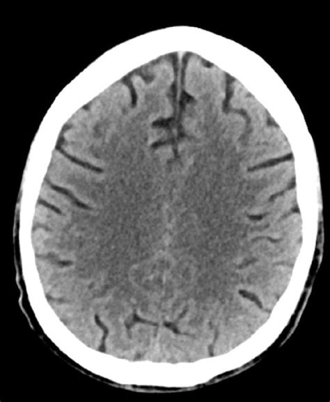 Image Normal Head Ct Scan Adult Age 74 Slide 2 Merck Manuals