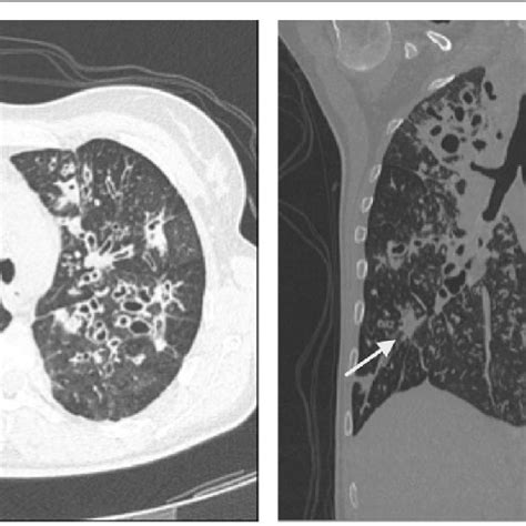 High Resolution Computed Tomography Hrct Of The Patient 1′ Lungs A