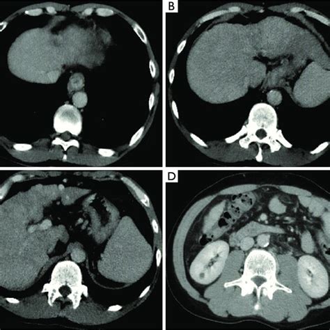 Abdominal Contrast Enhanced Ct Scans During Hospitalization On May 29