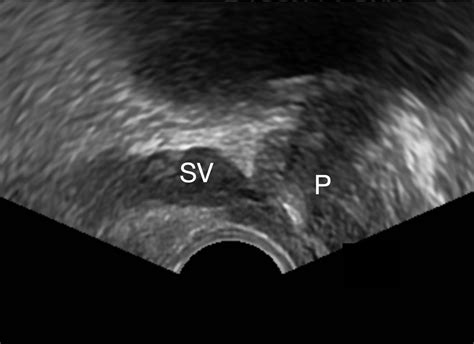 Transrectal Ultrasound Of Prostate Telegraph