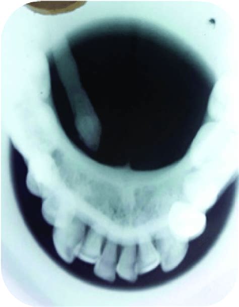 Occlusal View Radiograph Showing Submandibular Sialolith Of Case 1