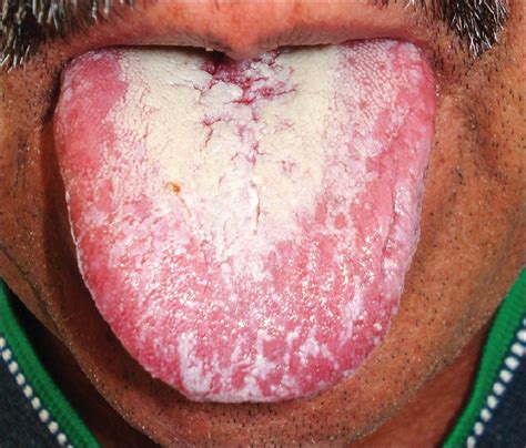 Fungal infections of the oral mucosa Krishnan P A - Indian J Dent Res
