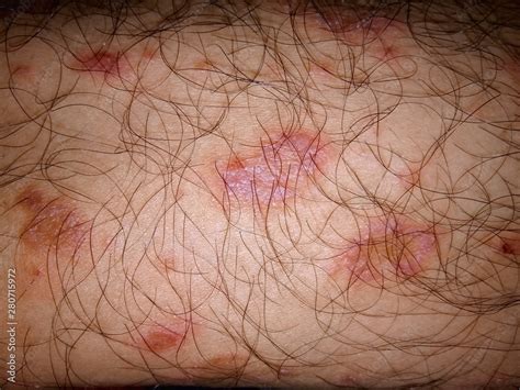 Pityriasis Rosea On Skin Closeup Fungal Infections That Cause Rashes