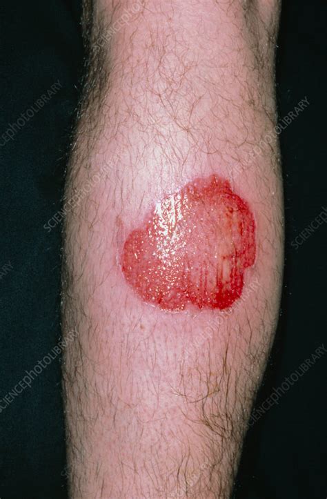 Infected Leg Burn From Steam Cleaner Stock Image M3350098