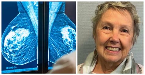 Woman Died From Stage Iv Breast Cancer After Doctor Misread Her