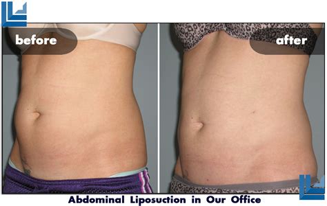 Abdominal Liposuction St Louis Laser Liposuction Center