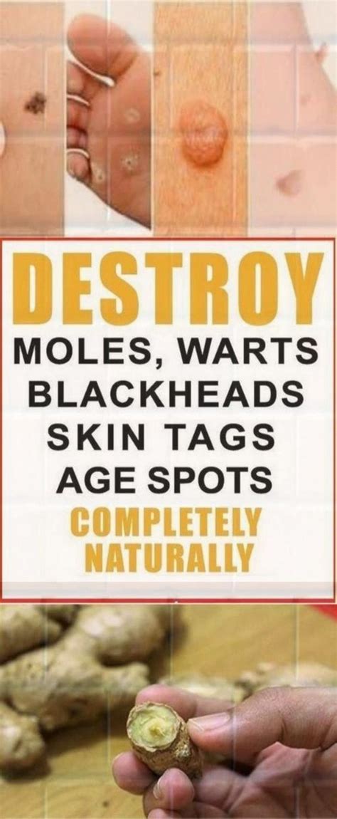 How To Get Rid Of Warts Moles Age Spots And Skin Tag Using Natural