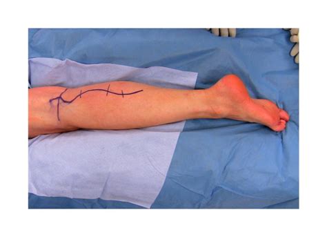 Tibial Nerve Decompression At The Soleus Surgical Education Learn Surgery Washington