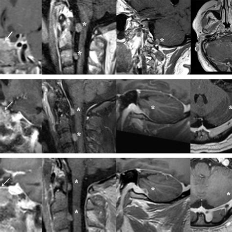 gadolinium enhanced t1 weighted magnetic resonance imaging of the download scientific diagram