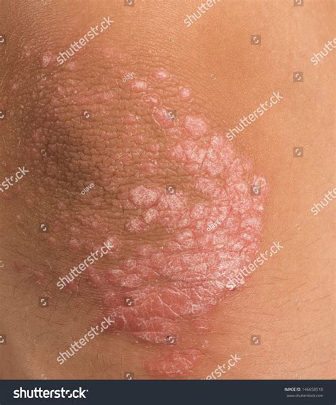 Psoriasis Skin Disorder On An Elbow Stock Photo 146658518 Shutterstock