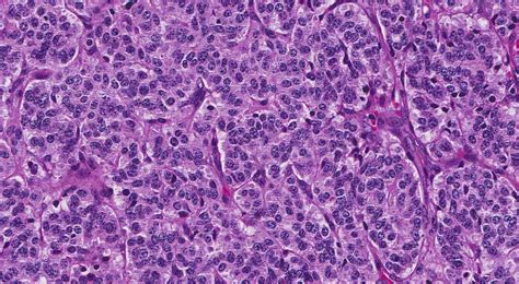 Atypical Carcinoid Tumour Of The Lung Mypathologyreportca
