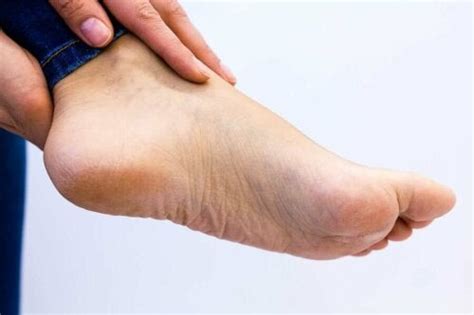 What Causes Yellow Skin On The Bottom Of The Feet Step To Health