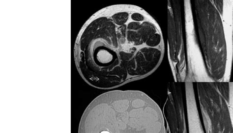 Soft Tissue Metastasis Located Close To The Femur In A Lung Cancer