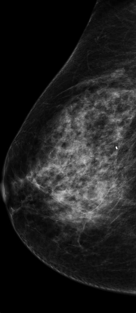 Artificial Intelligence Expedites Breast Canc Eurekalert