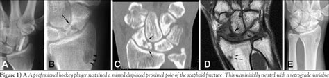 Figure 1 From Incorrect Radiographic Evaluation After Vascularized Bone
